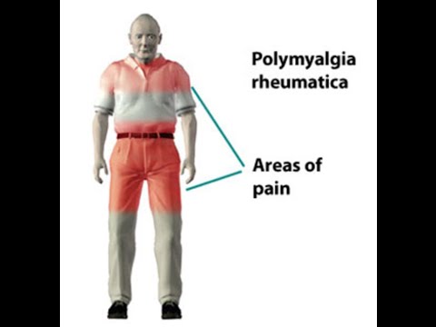 Video: Rozdiel Medzi Polymyalgia Rheumatica A Reumatoidná Artritída