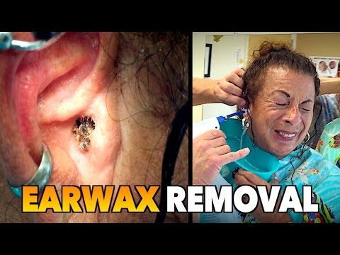 MASSIVE EARWAX REMOVAL! | Dr. Paul (feat. Maiya "My Wife")