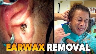 massive earwax removal dr paul feat maiya my wife