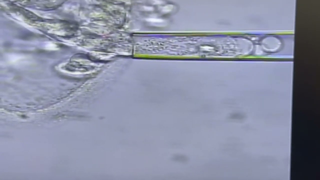 Embryo Biopsy - Dr. Sherman Silber - Infertility Center for St. Louis