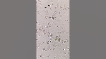 Epithelial cells in urine under the microscope #laboratory #medtechstudent #mls #cls #urinesediment