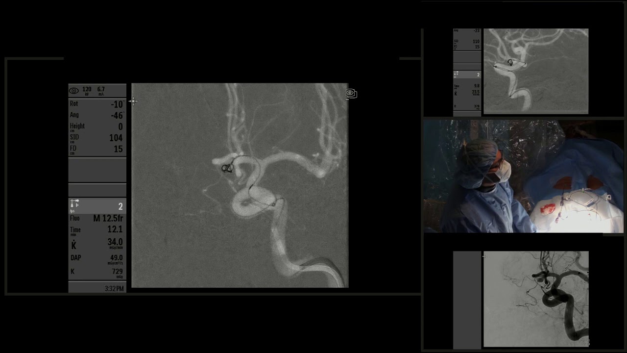 Endovascular coil embolization of 2 cerebral aneurysms YouTube