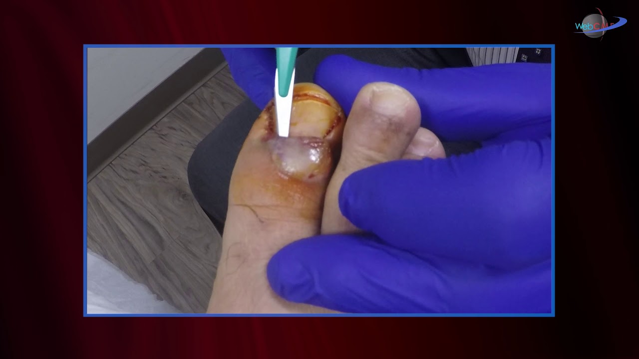 WCW: Draining a Dermal Abscess Near the Base of the Toe