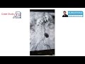 #Case Study-Aortic Aneurysm | Dr.Srikanth Raju | Vascular and Endovascular Surgeon | Hyderabad