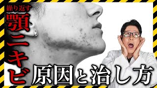 [How to cure chin acne/Doctor's explanation] Causes of recurring chin acne and how to cure it