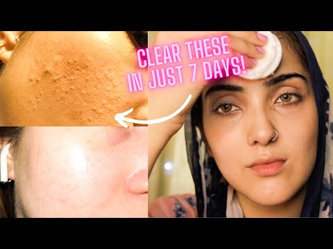 HOW TO REMOVE TINY BUMPS ON FOREHEAD! Fungal Acne Remedy~ Immy