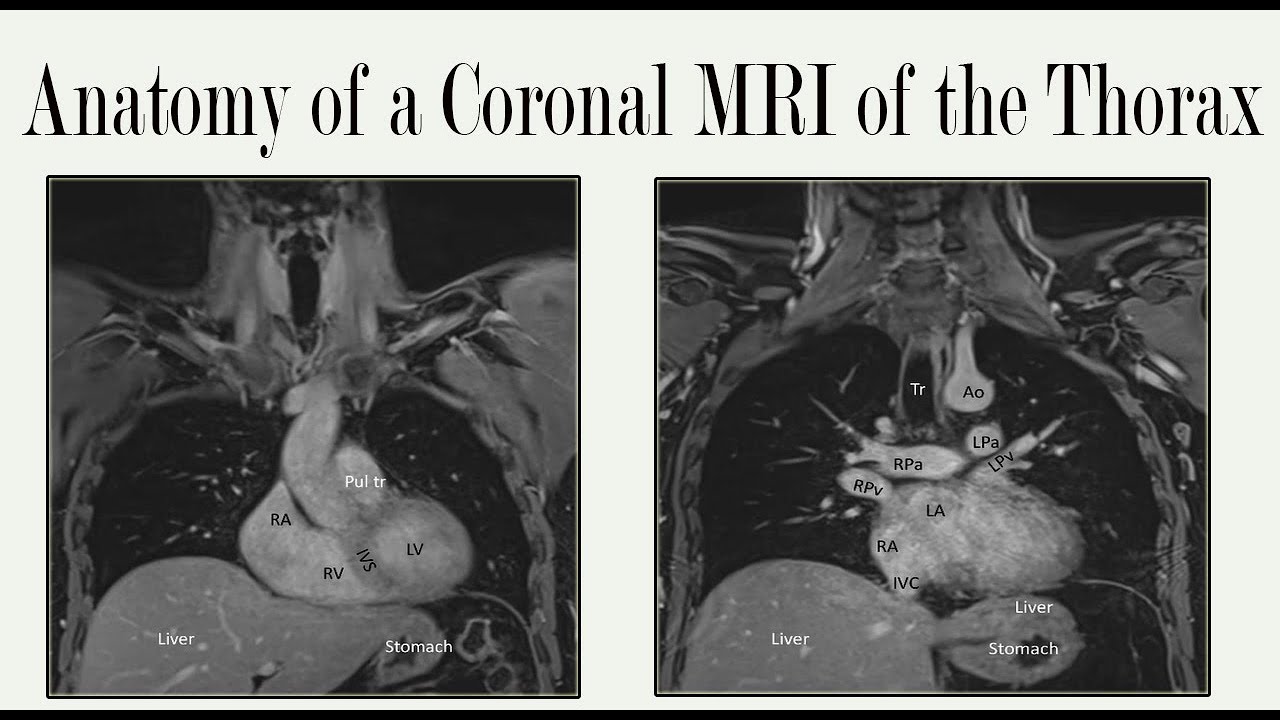 Anatomy of a Coronal MRI of the Thorax YouTube