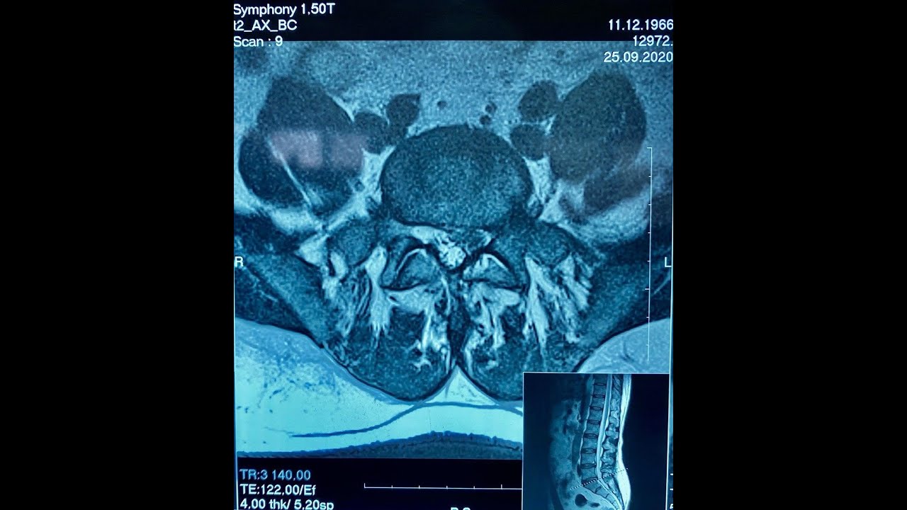 Грыжа диска l5 s1 что это. Грыжа диска l5-s1. Фораминальный стеноз на уровне l5-s1. Бипортальная эндоскопия позвоночника.
