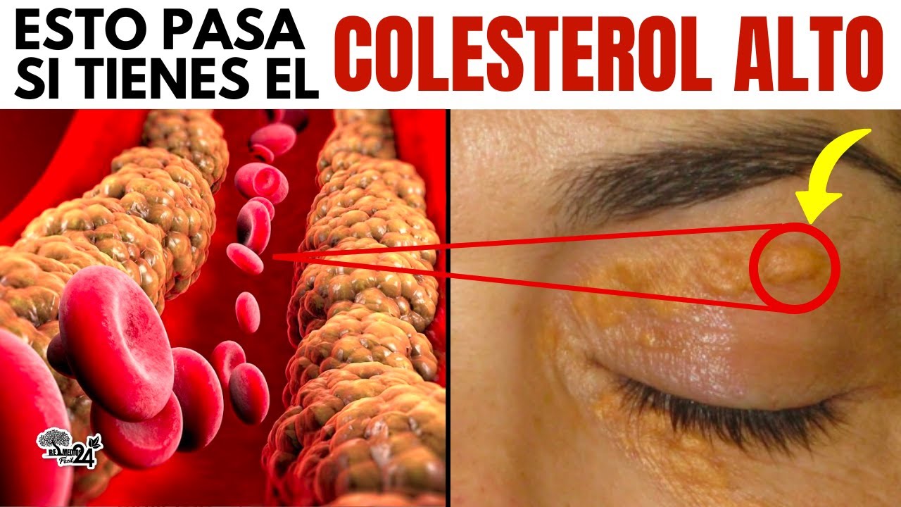 señales de colesterol alto