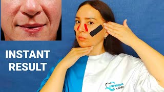 How to Get Rid of Nasolabial Folds (Smile Lines) without Injections of Filler | Kinesiology Tape |