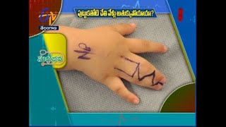 Syndactyly in Children | Sukhibhava | 19th October 2021 | ETV Telangana