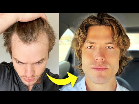 How I Stopped My Receding Hairline Mens Hair Loss Guide  YouTube