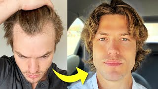 My Turkey Hair Transplant Results After 1 Year | Before \& After