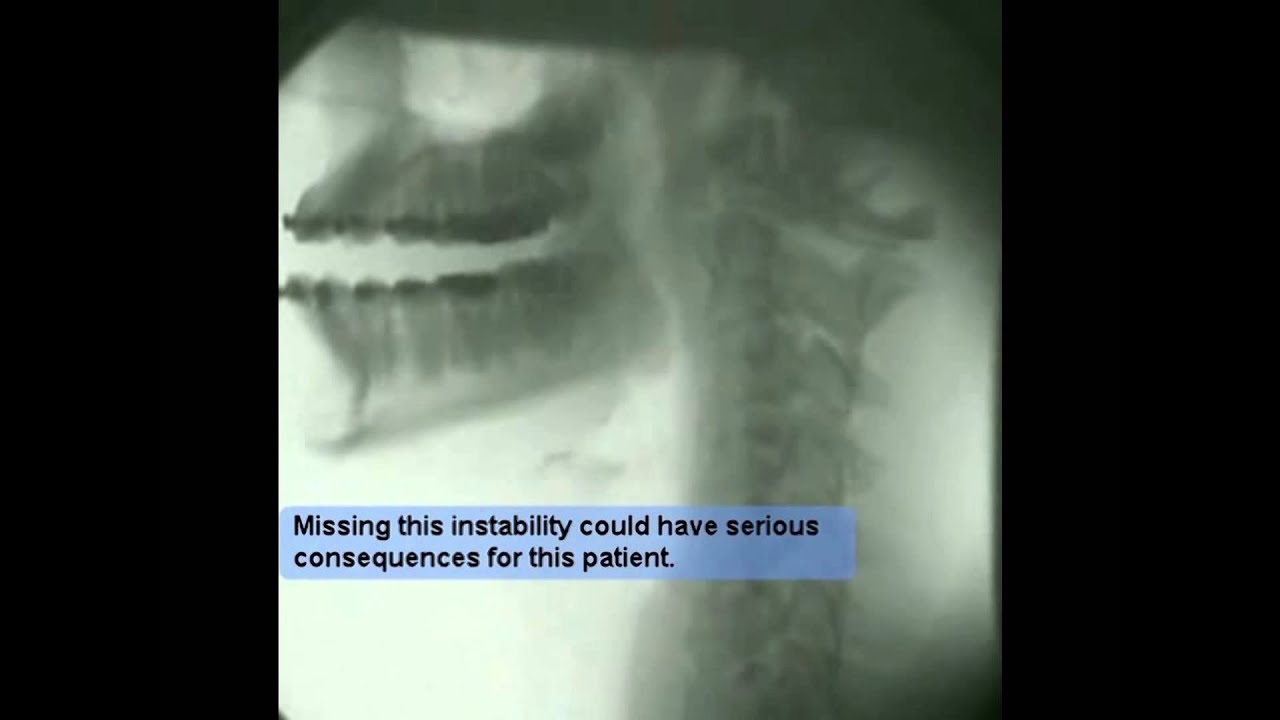 Upper Neck Instability Car Accident YouTube