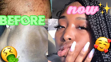 How can I get clear skin in 2 days naturally?