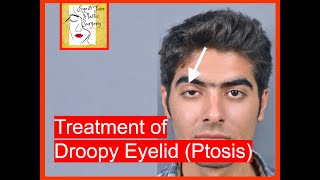 Droopy Eyelid (ptosis): Treatment and Surgery