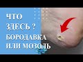 Что там? Стержневая мозоль или вирусная бородавка.