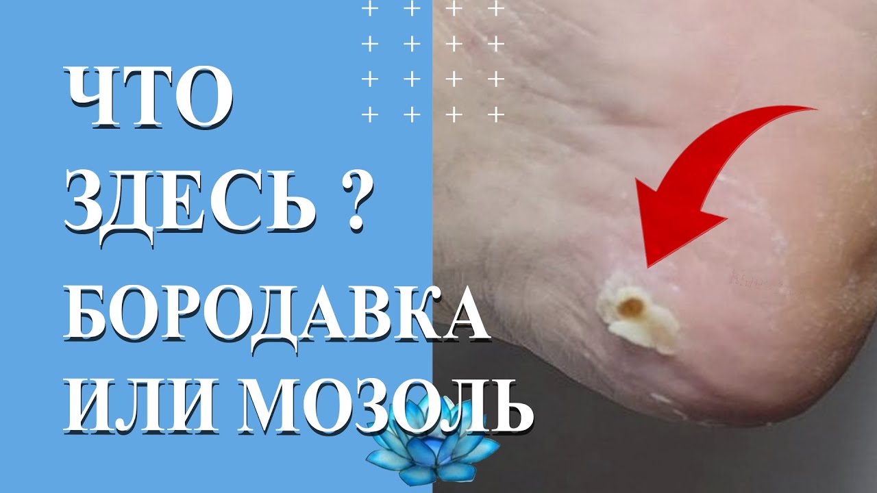 Что там? Стержневая мозоль или вирусная бородавка. - YouTube
