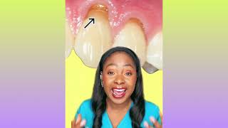 Shocking reason why your teeth are yellow😱 #rdh #hygienist