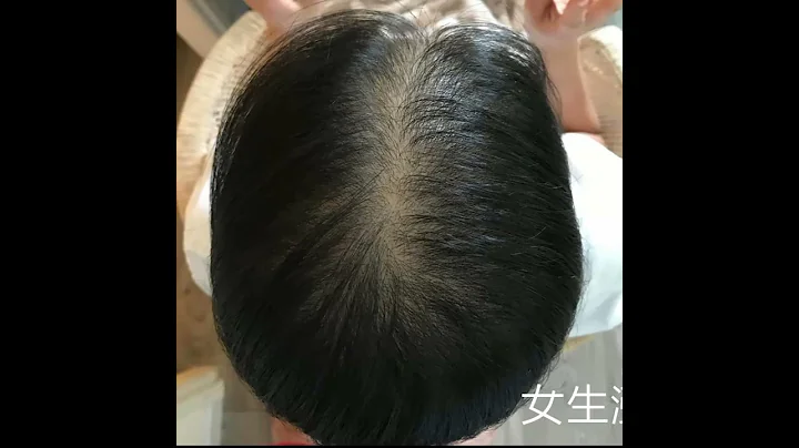 女性脫髮 治癒女性頭髮稀疏，只需且只有這3種方案 - 天天要聞