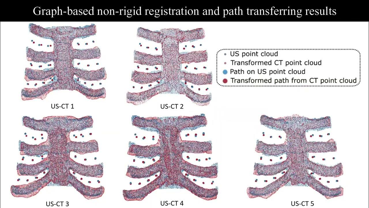 Thoracic Cartilage UltrasoundCT Registration using Dense Skeleton