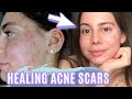 HEALING SCARS OVERNIGHT || MY ACNE SCAR EVENING SKINCARE ROUTINE 2020!!