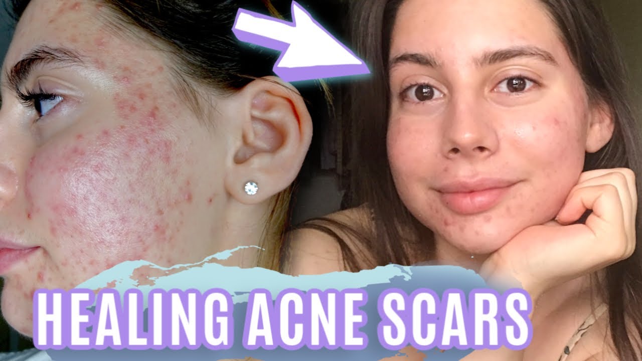 HEALING SCARS OVERNIGHT || MY ACNE SCAR EVENING SKINCARE ROUTINE 2020!!