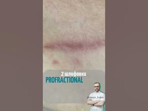 лечение рубца через пол года после #рубцы #шрам #шлифовка #косметолог # ...