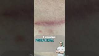 лечение рубца через пол года после #рубцы #шрам #шлифовка  #косметолог #врачкосметолог  #пигментация