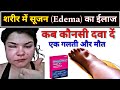 शरीर में सूजन का बेस्ट ईलाज // Edema treatment in hindi // body swelling