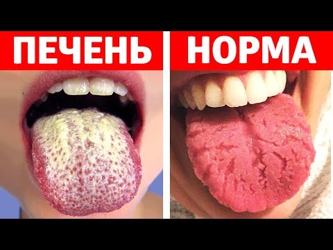 ЕСЛИ ТВОЙ ЯЗЫК ВЫГЛЯДИТ ТАК, БЕГИ К ДОКТОРУ!