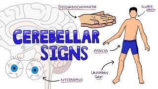 Cerebellar Dysfunction Signs Mnemonic  DANISH: What are the Signs of Cerebellar Dysfunction?