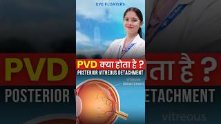 Seeing Floaters or Flashes? Posterior Vitreous Detachment Explained