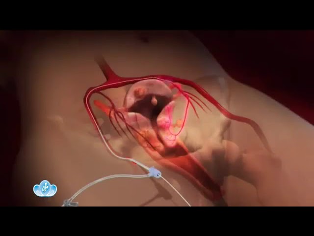 Миома матки Эмболизация маточных артерий