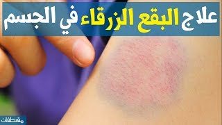 علاج البقع الزرقاء في الجسم