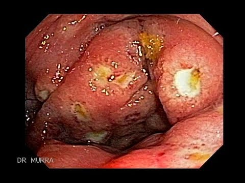 Video: Ulcera Del Colon Nei Gatti