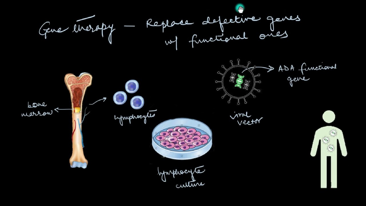 Gene therapy | Biotechnology and its Applications | Biology | Khan Academy