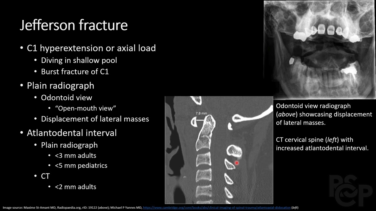 Spine Fractures, part 2