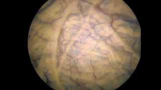Cystoscopy in diagnosis of interstitial cystitis/bladder pain syndrome
