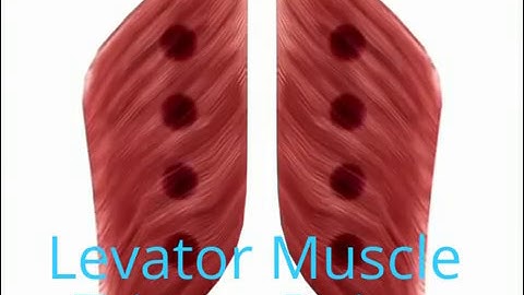 Trigger Point Syndrome : Cause, Classification, Detection and Injection