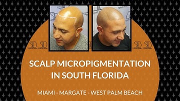 Scalp Micropigmentation Video Testimonial - What to expect?!?!