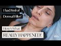 Full Face Dermal Filler! 😱 Here's what REALLY happened! (2021)