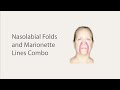 Face Taping for Nasolabial Folds and Marionette Lines
