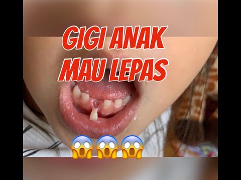 Video: Ketika Gigi Susu Pada Anak-anak Tanggal