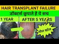 2019 - Actual reason behind Hair Transplant failure | कोई नही बताएगा ये बात | कड़वा सच 😡