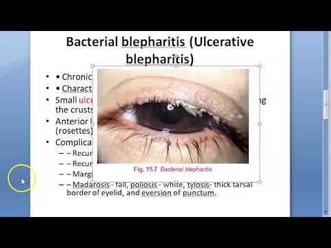 Ophthalmology 371 a Blepharitis Eye Lid Margin Inflammation Swelling Bacterial Ulcerative