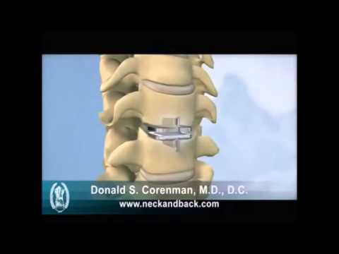 ხელოვნური მალთაშუა დისკის იმპლანტაცია