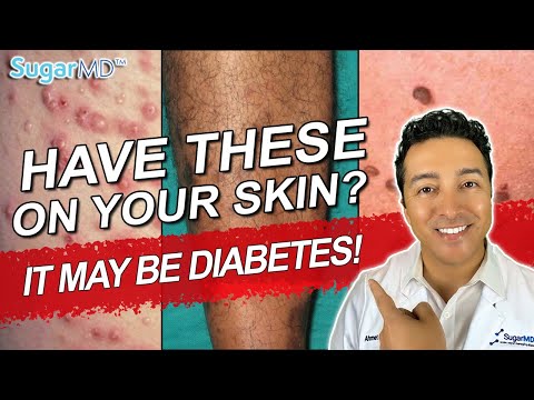 12 Diabetic Skin Problems & Top Signs of Diabetes on The Skin!