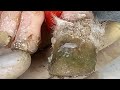 The Thickness Of These Toenails Is Amazing! Pedicure Step By Step Infected With Fungus 0412M30401