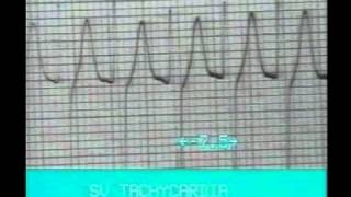 14.Atrial Rythms.rmvb